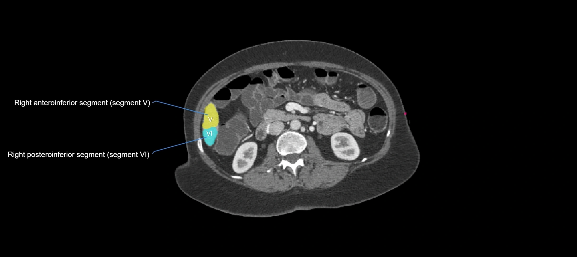 CT liver segments axial cross sectional anatomy labelled image-00010.webp